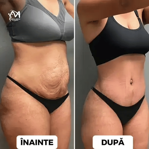 Benficiile utilizării SlimGel Skin Protect